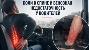 Боли в спине и венозная недостаточность у водителей: риски профессии и что с этим делать